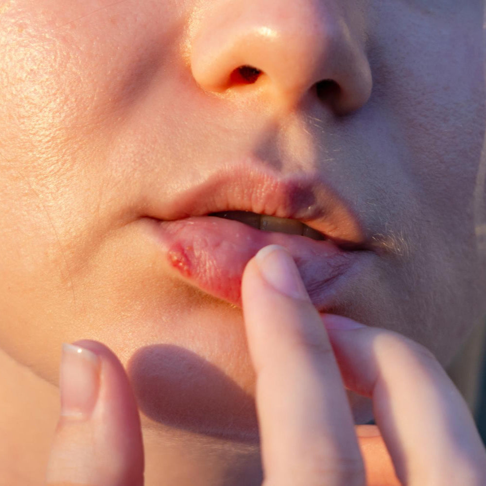 Herpes / Cold Sores